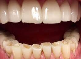 Treatments For Worn Teeth Repair: You Can Get Your Smile Back!